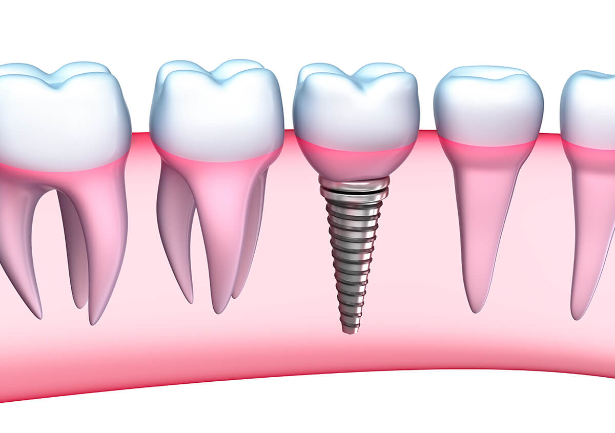 Affordable Dental Implants in Leominster MA Area