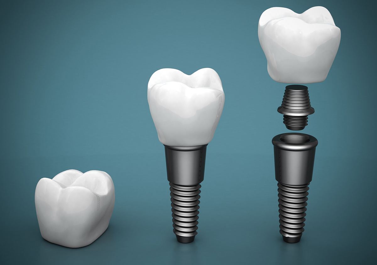 How Painful Are Dental Implants Near Me In Leominster MA Area