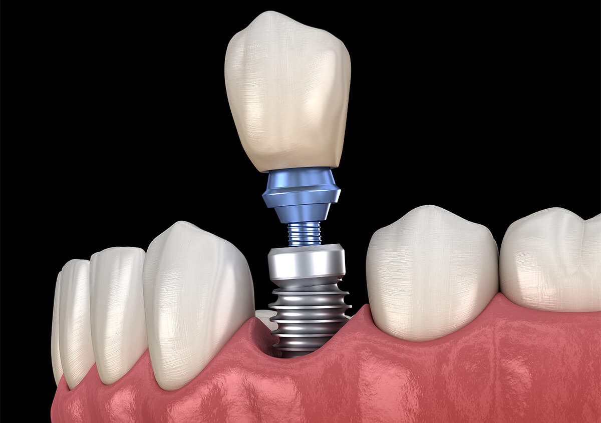 Full Arch Dental Implants in Leominster MA Area
