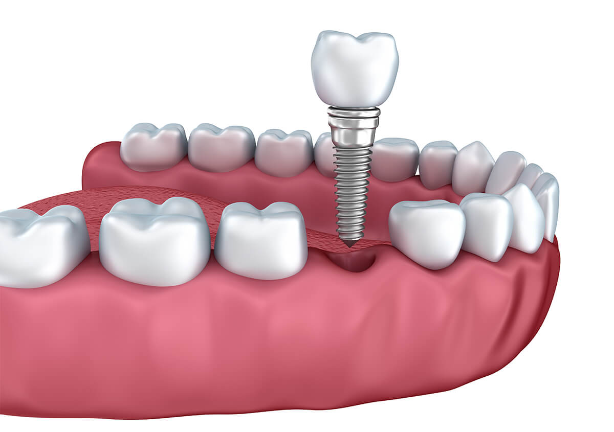 Replace Front Teeth With Implants in Leominster MA Area